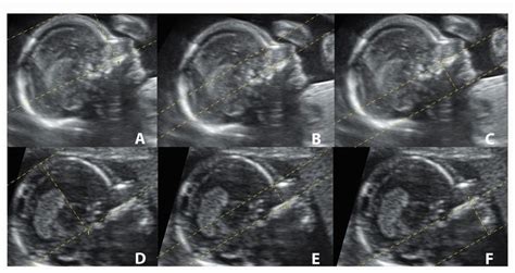 down syndrome tits|Fetal breasts in normal and Down syndrome fetuses